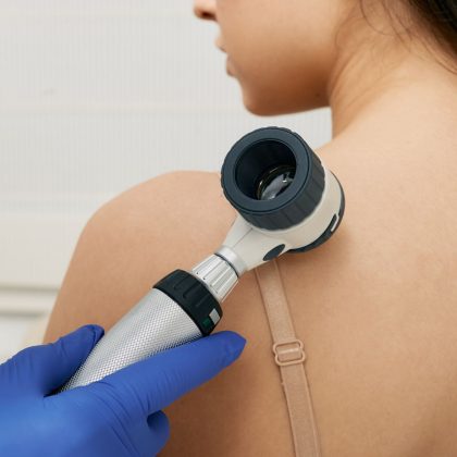 Mole dermoscopy. Physician check-up of a patient's skin with a dermatoscopy for prevention of melanoma and skin cancer, close-up.